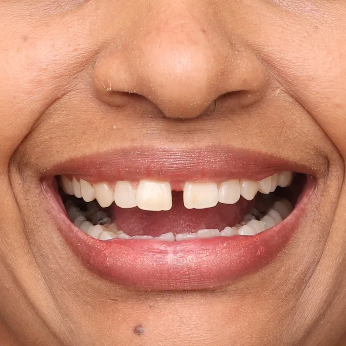 espaços entre os dentes da frente antes do tratamento