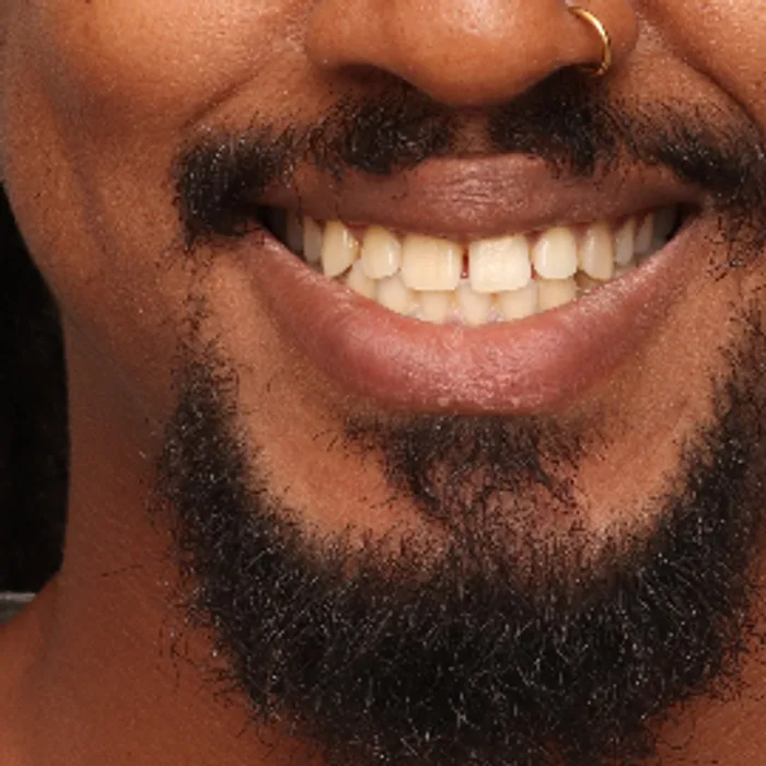 rosto sorrindo antes do tratamento