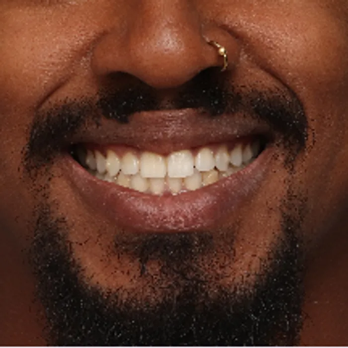 rosto sorrindo depois do tratamento