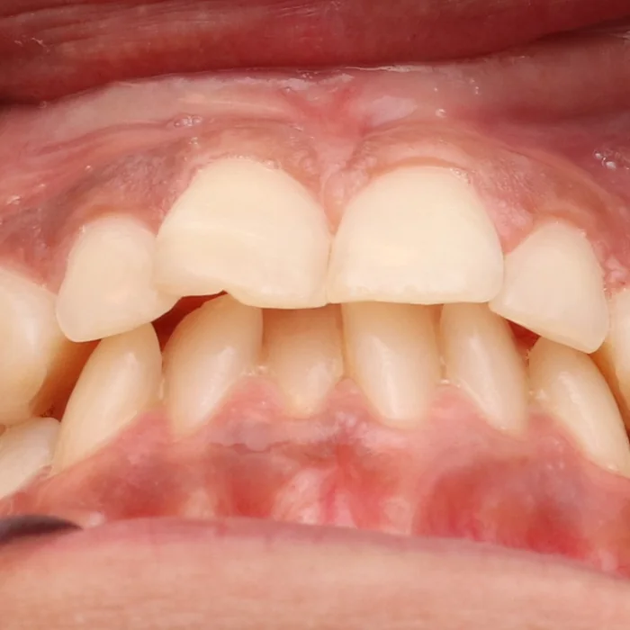 dentes girados com bordas irregulares antes do tratamento