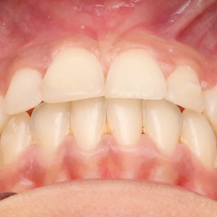 dentes alinhados com bordas niveladas depois do tratamento
