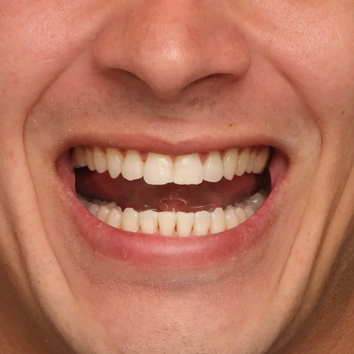 sorriso mais amplo e alinhado depois do tratamento
