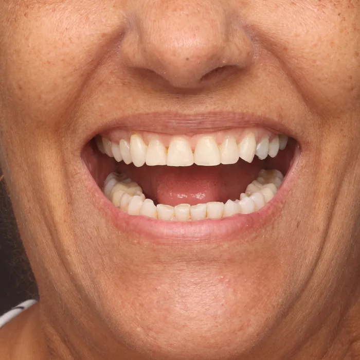 sorriso alinhado e nivelado depois do tratamento