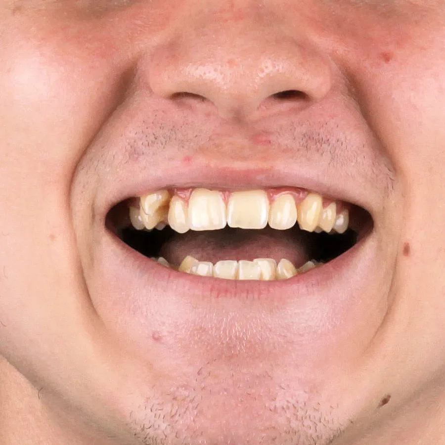 sorriso antes do tratamento com alinhadores