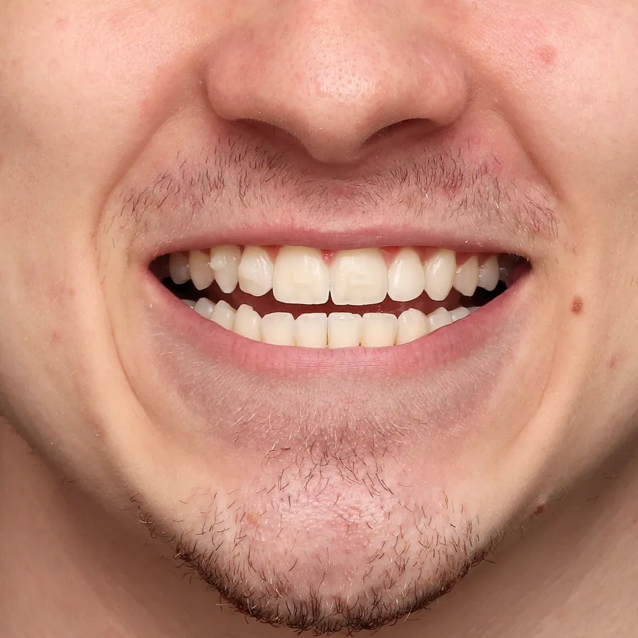 sorriso depois do tratamento com alinhadores