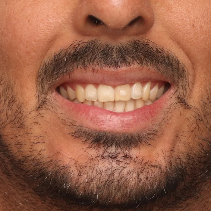 dentes alinhados e nivelados depois do tratamento