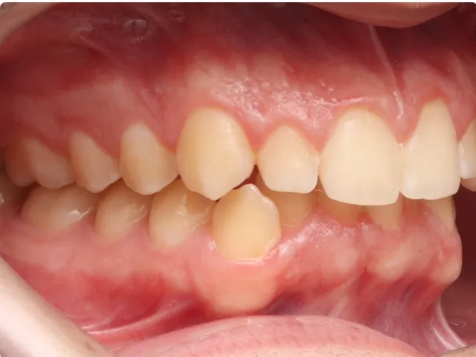 apinhamento dentário antes do tratamento
