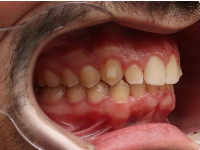dentes alinhados depois do tratamento