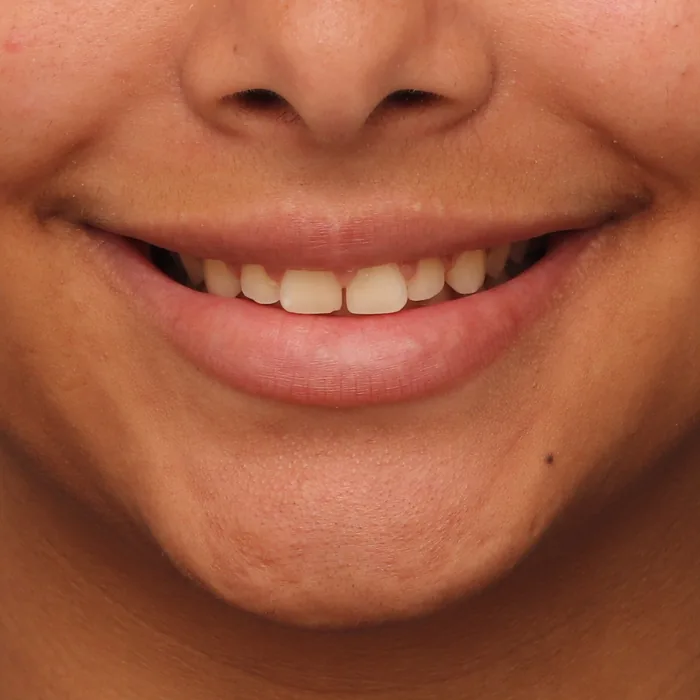 bordas dos dentes desniveladas antes do tratamento