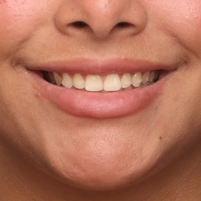 sorriso nivelado depois do tratamento com alinhadores