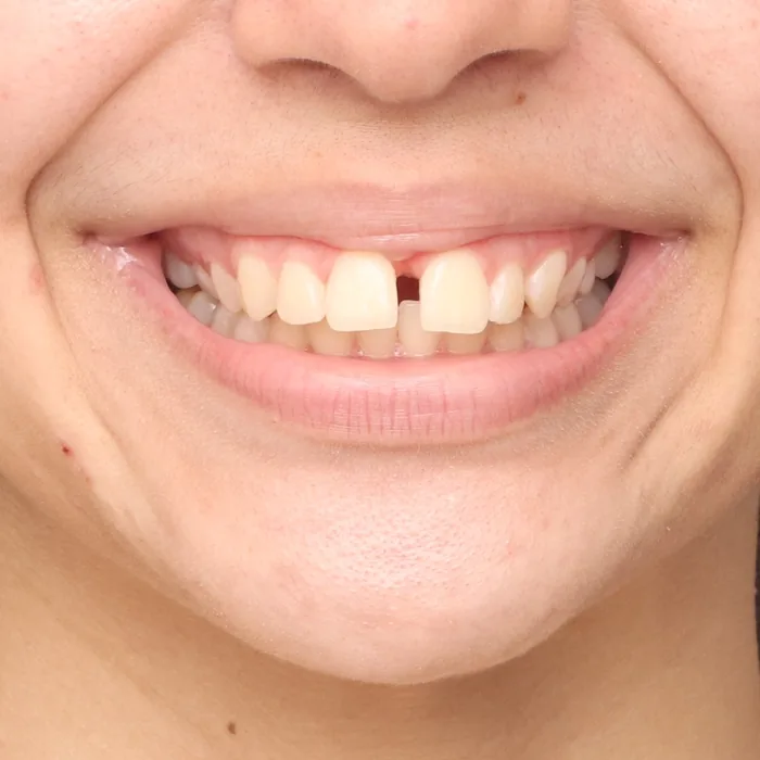 diastema entre os dentes da frente antes do tratamento