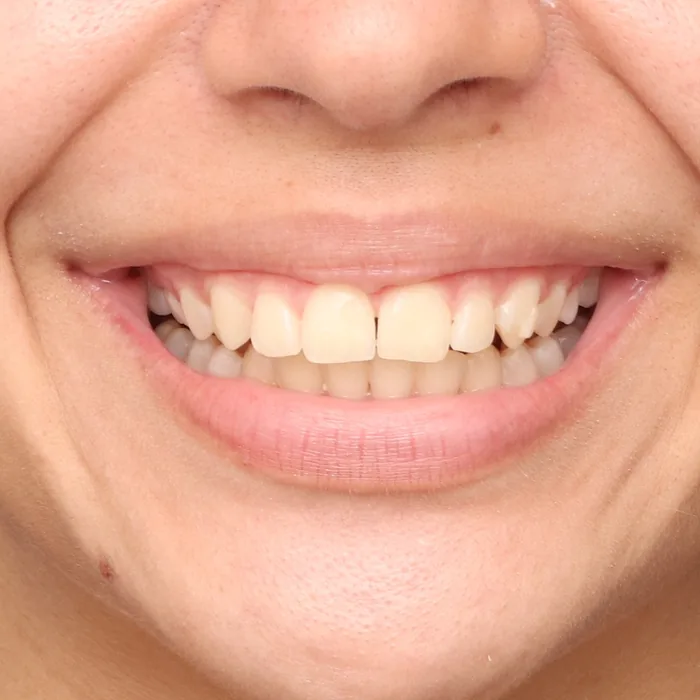 diastema fechado depois do tratamento com alinhadores