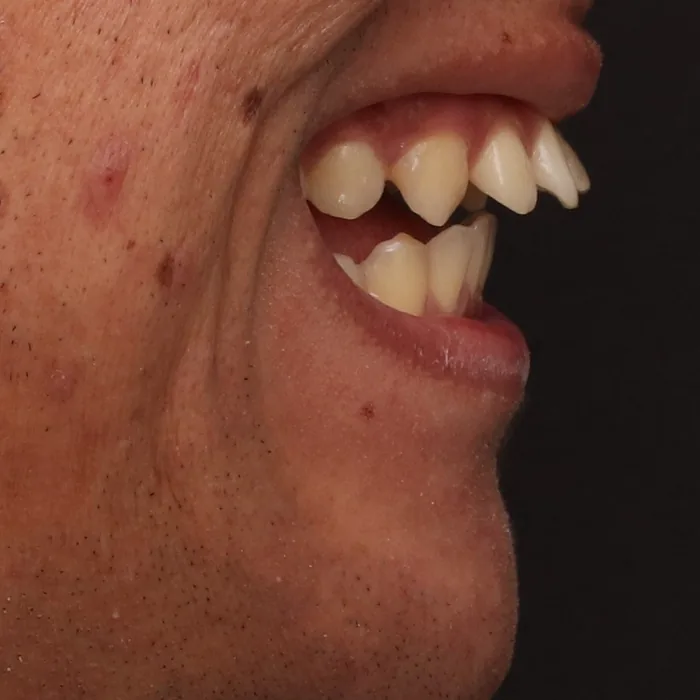 perfil com dentes da frente projetados antes do tratamento