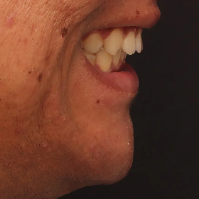 perfil com dentes recuados e mordida fechada depois do tratamento