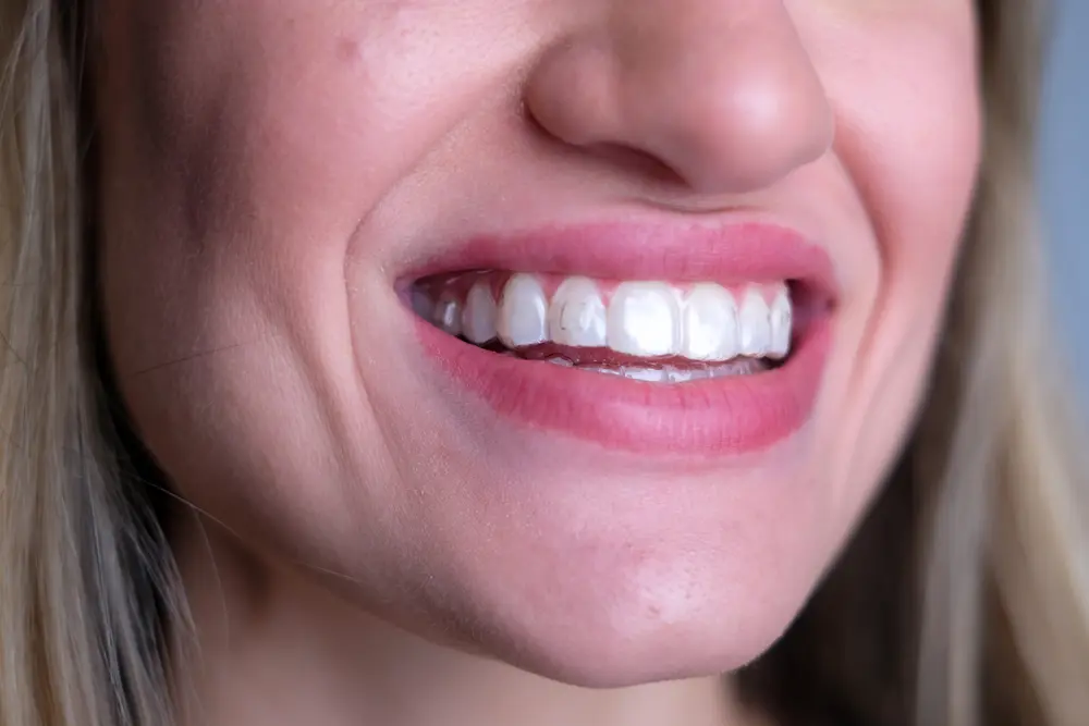 sorriso com alinhador transparente em uso