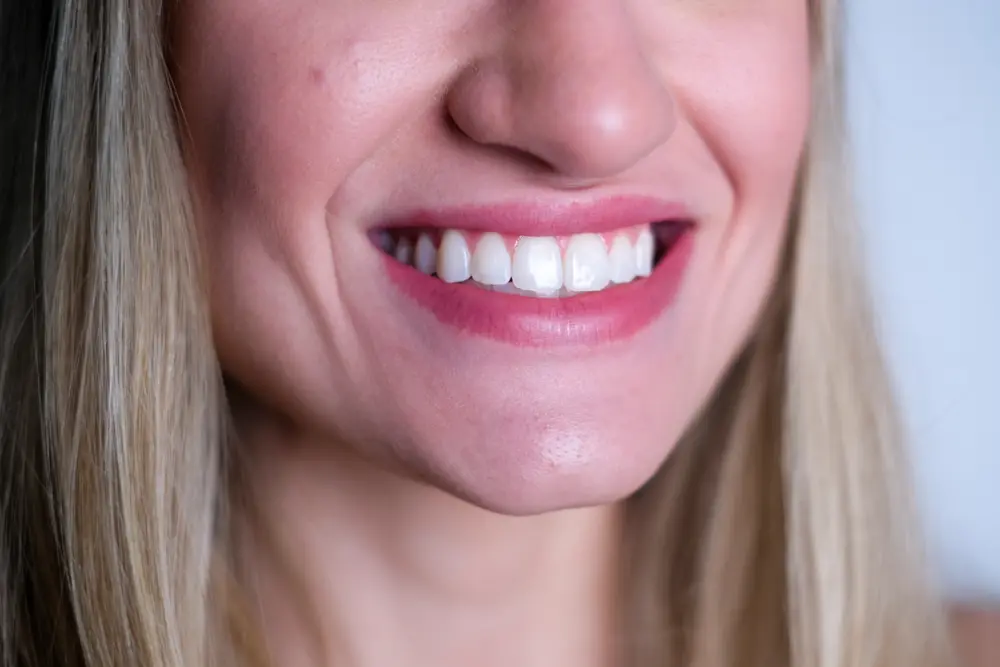 sorriso alinhado após tratamento